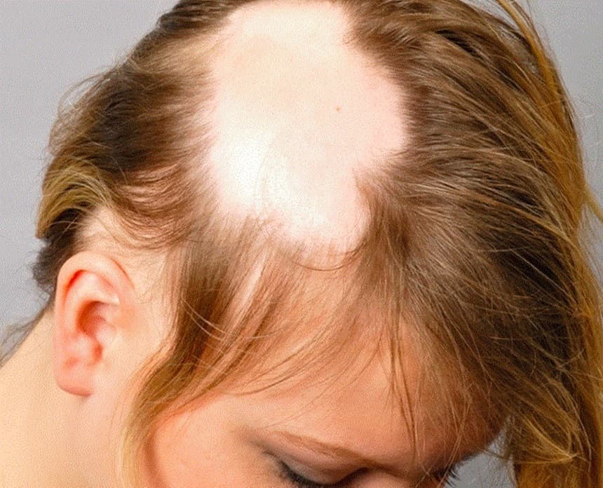 No momento, você está visualizando Alopecia androgenética feminina