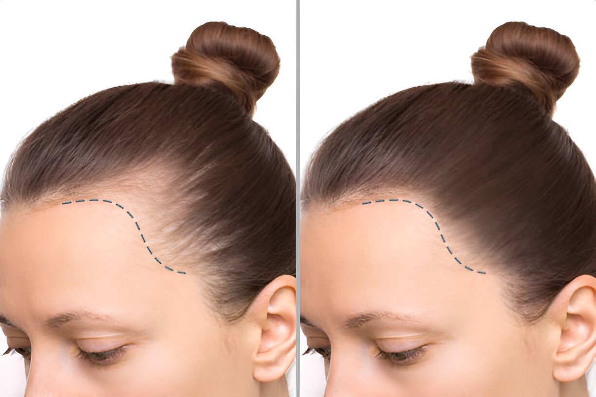 No momento, você está visualizando Mitos e Verdades Sobre o Transplante Capilar Feminino